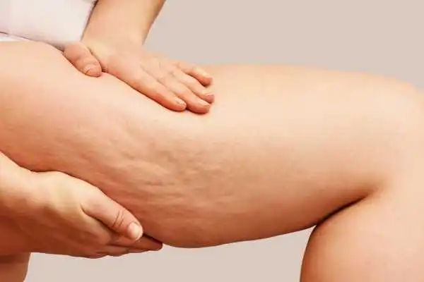 Image of woman showing leg with cellulite Cookham
