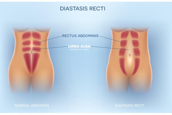 What Non-Surgical Options Are Available for Diastasis Recti Cookham?