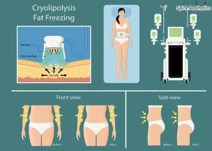 Fat freezing treatment Cookham benefits for competitions to remove stubborn fat deposits.