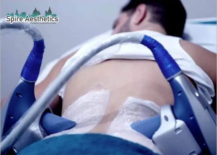 Man having fat freezing treatment done on love handles before a competitions Cookham to create a sculpted look.