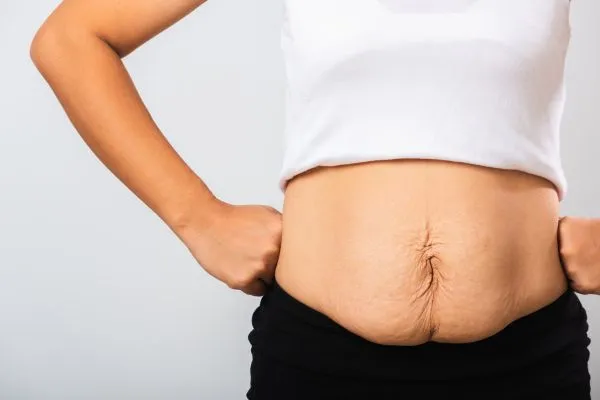 Image of a woman's stomach after weight loss with sagging skin following a gastric band Cookham
