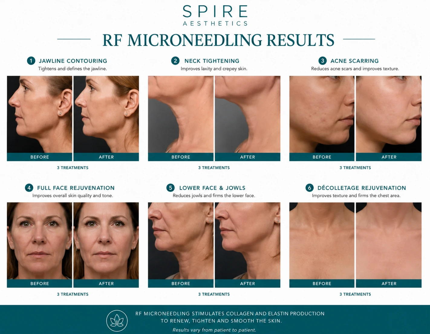 RF Microneedling Skin tightening Cookham results