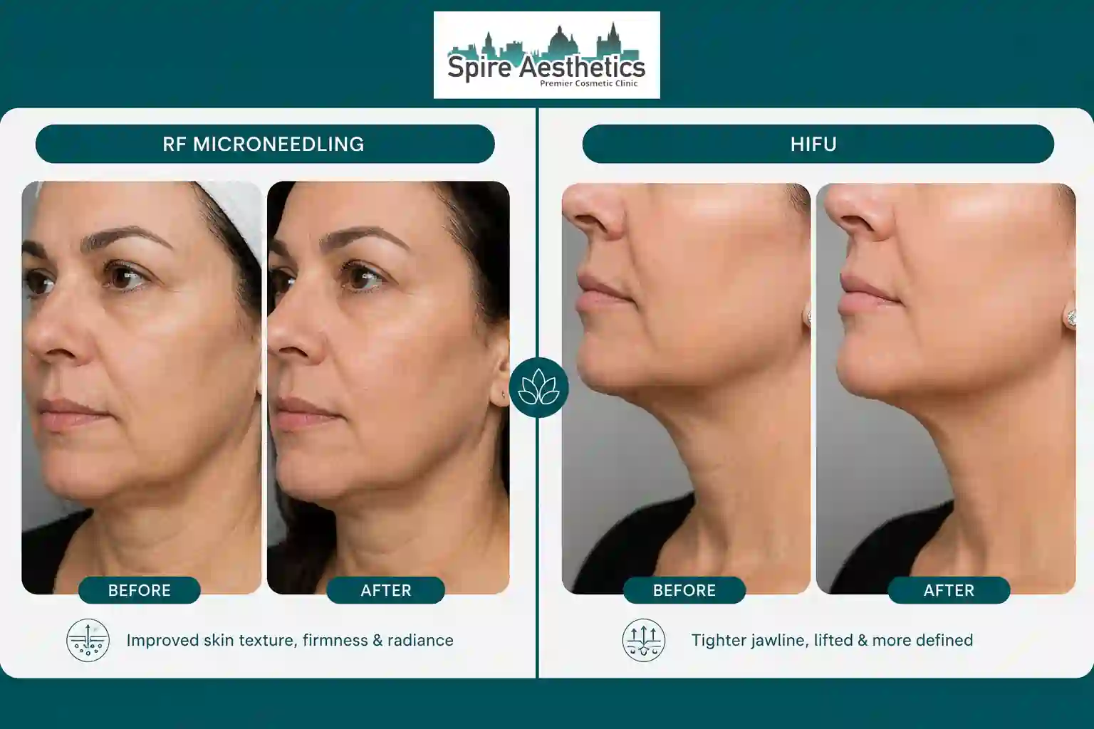 Can RF Microneedling and HIFU Be Combined Cookham?