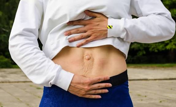 When Could Diastasis Recti Be the Missing Piece of the Puzzle Cookham?