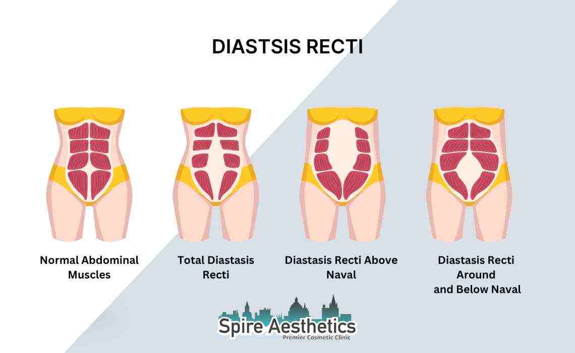 Is Non-Surgical Diastasis Recti Treatment Right for You? Common Concerns Answered Cookham